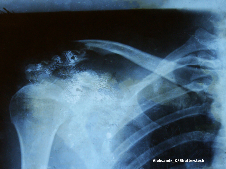 fractured clavicle
